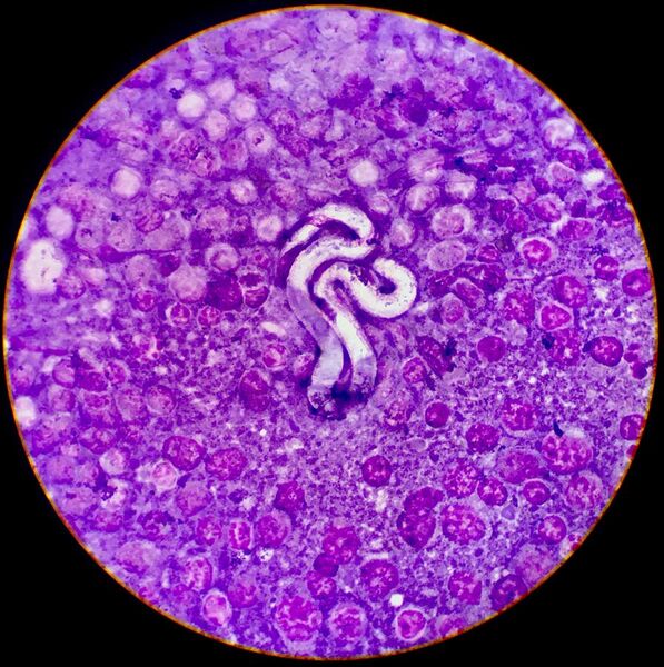 File:Microfilaria of Dirofilaria immitis (Heartworms) Surrounded by Neoplastic Lymphocytes 1.jpg