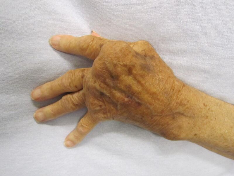 File:Rheumatoid Arthritis.JPG