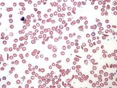 Sickle Cell Blood Smear.JPG