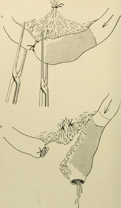 Illustration of resection of bowel segment as performed in the early 1900s.