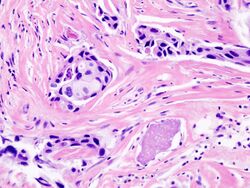 Histopathology of invasive ductal carcinoma of the breast representing a scirrhous growth.