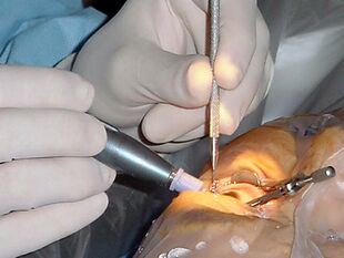 close-up photo showing the hands of a surgeon holding phaco instruments inserted into the patient's eye. The eyelids are held apart by a speculum.