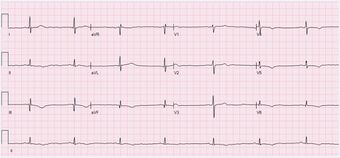 An ECG showing sinus bradycardia at 43 bpm. The image is made up of a red grid on a white background. A black line traces the patients heart beat.