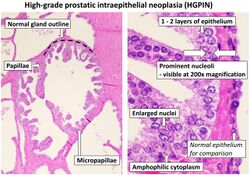 Histopathology of high-grade prostatic intraepithelial neoplasia (HGPIN), annotated.jpg