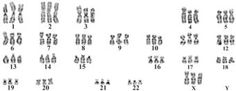 Human triploid karyotype.jpg