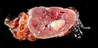 Adrenal paraganglioma clinical Pheochromocytoma.jpg