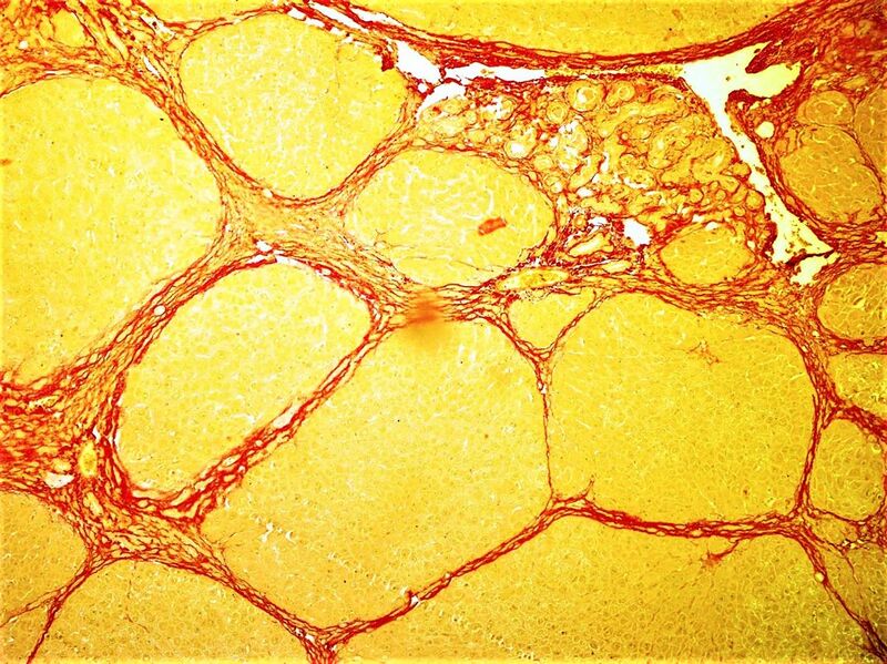 File:Bridging fibrosis in rat liver exposed to thioacetamide.jpg