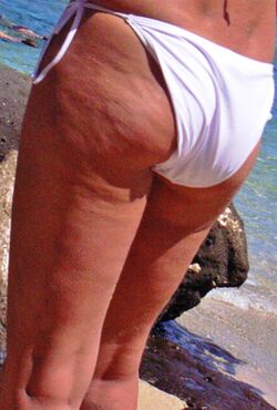 Dimpled appearance of cellulite.jpg