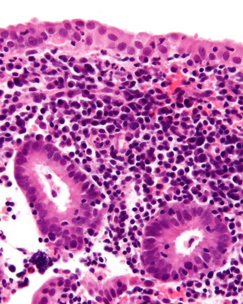 File:Endometritis - 2 - cropped - very high mag.jpg