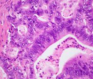 Histopathology of pancreatic ductal adenocarcinoma.jpg