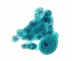 Serous carcinoma 2c - cytology.gif