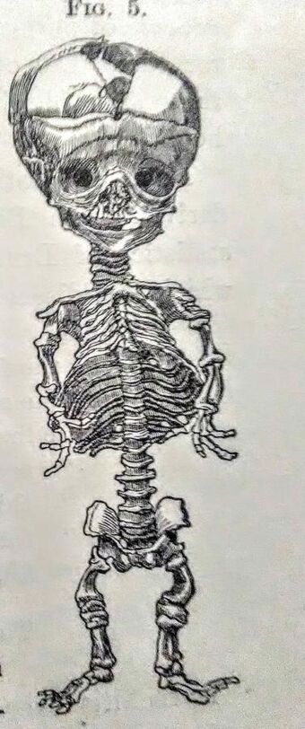 Skeleton Infant Rickets.jpeg