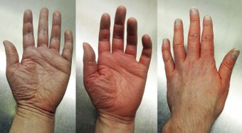 Erythromelalgia in left hand.jpg