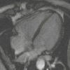 Four chamber cardiovascular magnetic resonance imaging.gif