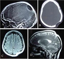 Gorham's disease.jpg