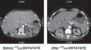 Lutetium-177 treatment CT scan.jpg