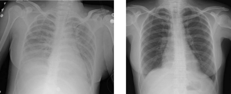 File:Transfusion-related acute lung injury chest X-ray.gif