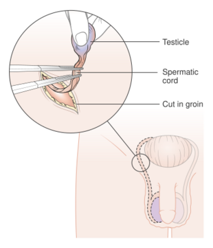 Diagram showing how the testicle is removed (orchidectomy) CRUK 141.svg