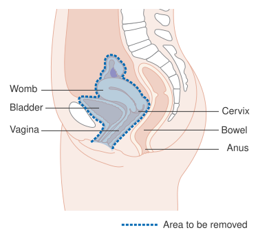 File:Diagram showing the area removed with an anterior exenteration operation for cancer of the cervix CRUK 290.svg