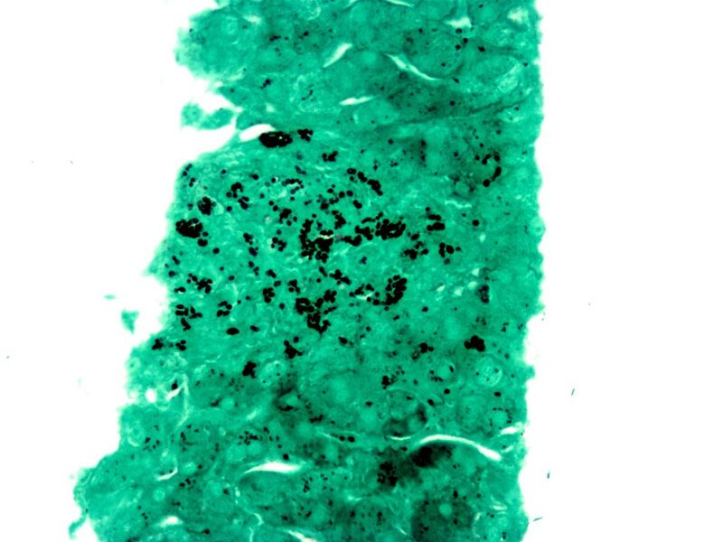 File:Histoplasma in granuloma gms.jpg