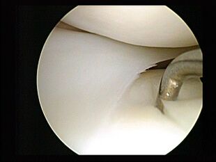 Lateral meniscus damaged tibial cartilage.jpg