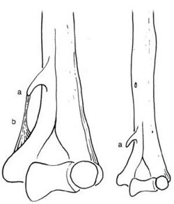 Ligament of Struthers 1854.jpg