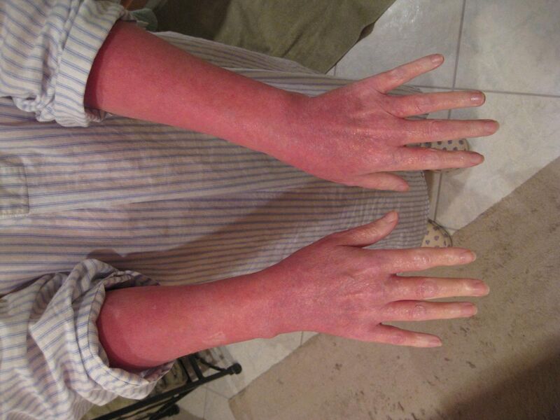 File:Red (burning) Skin Syndrome - Typical Pattern of Lower Arms & Hands.jpg