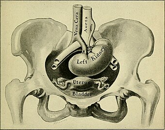 An labelled illustration showing an ectopic kidney inside an anatomically female human abdomen