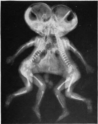 Conjoined X-ray.jpg