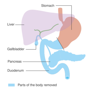 Diagram showing the area removed for surgery to remove all of the pancreas (total pancreatectomy) CRUK 287.svg