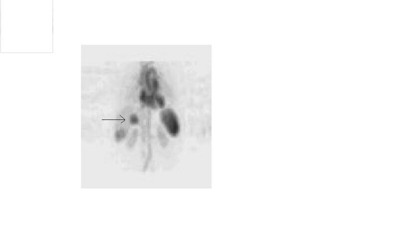 File:Hemangioma scan.jpg