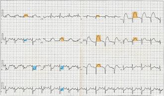 12 Lead EKG ST Elevation tracing color coded.jpg