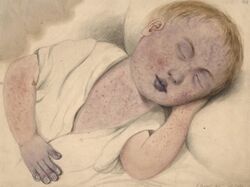 Child with measles modified by cyanosis Wellcome L0061496.jpg