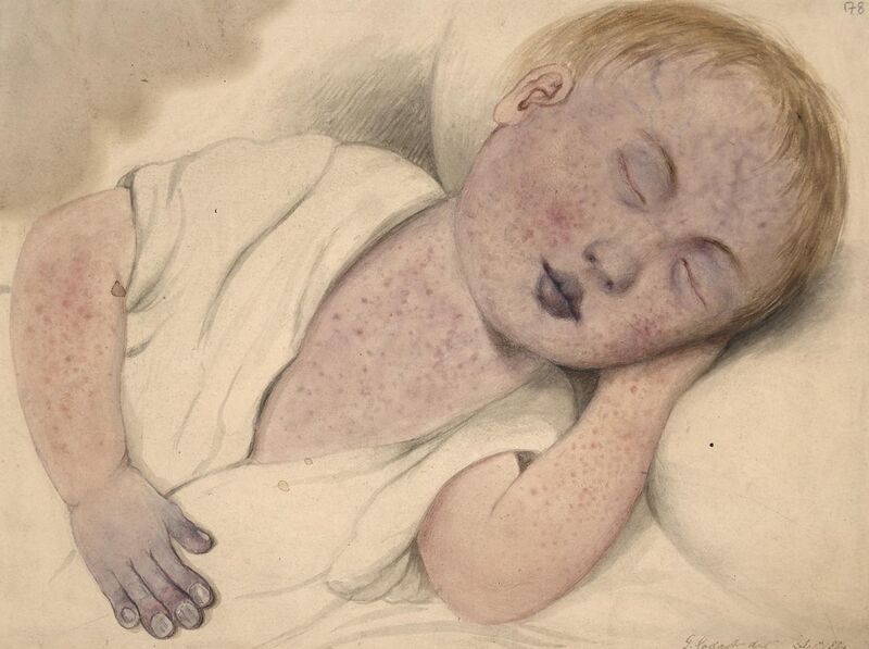 File:Child with measles modified by cyanosis Wellcome L0061496.jpg