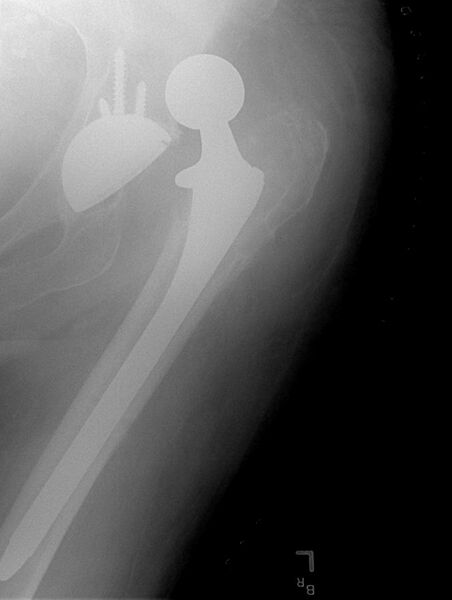 File:Dislocated hip replacement.jpg