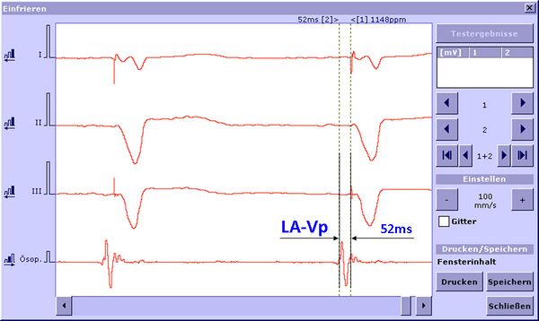 AV-Delay Optimierung 2