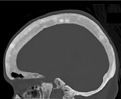CT of sclerotic lesions in the skull in renal osteodystrophy.jpg