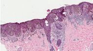 Histopathology of superficial spreading melanoma.jpg