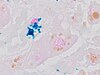 Kupffer cell with hemosiderin and hepatocyte with lipofuscin, iron stain, original.jpg