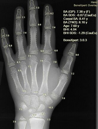X-ray of hand, where bone age is automatically found by BoneXpert software.jpg