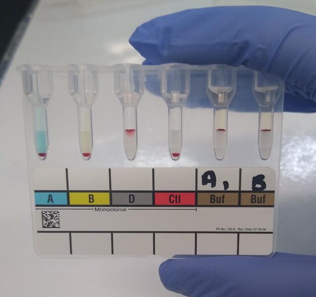 File:Blood typing by gel card method (column agglutination or MTS gel) - type O positive.jpg