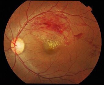 Branch retinal vein occlusion.jpg
