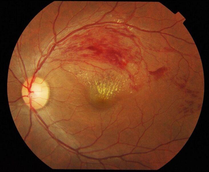 File:Branch retinal vein occlusion.jpg