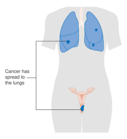 Diagram showing stage 4B vaginal cancer CRUK 240.svg