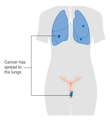 File:Diagram showing stage 4B vaginal cancer CRUK 240.svg