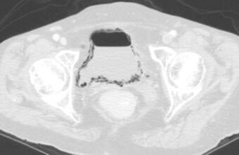 Emphysematous Cystitis CT ax-5.jpg