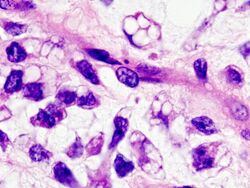 Myxoid liposarcoma (06).JPG