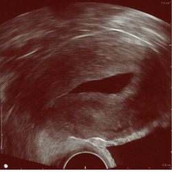 Normal hysterosonography.png