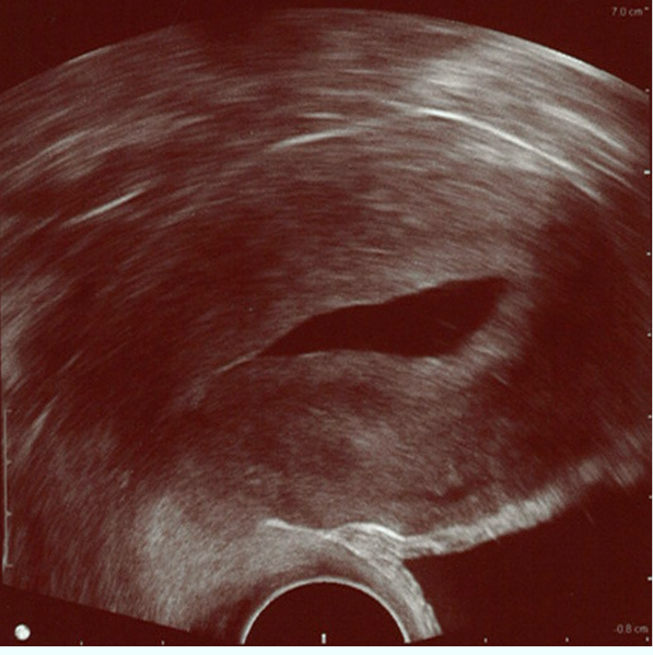 File:Normal hysterosonography.png