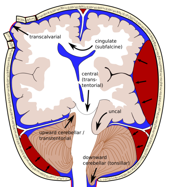 File:Brain herniation types-2.svg